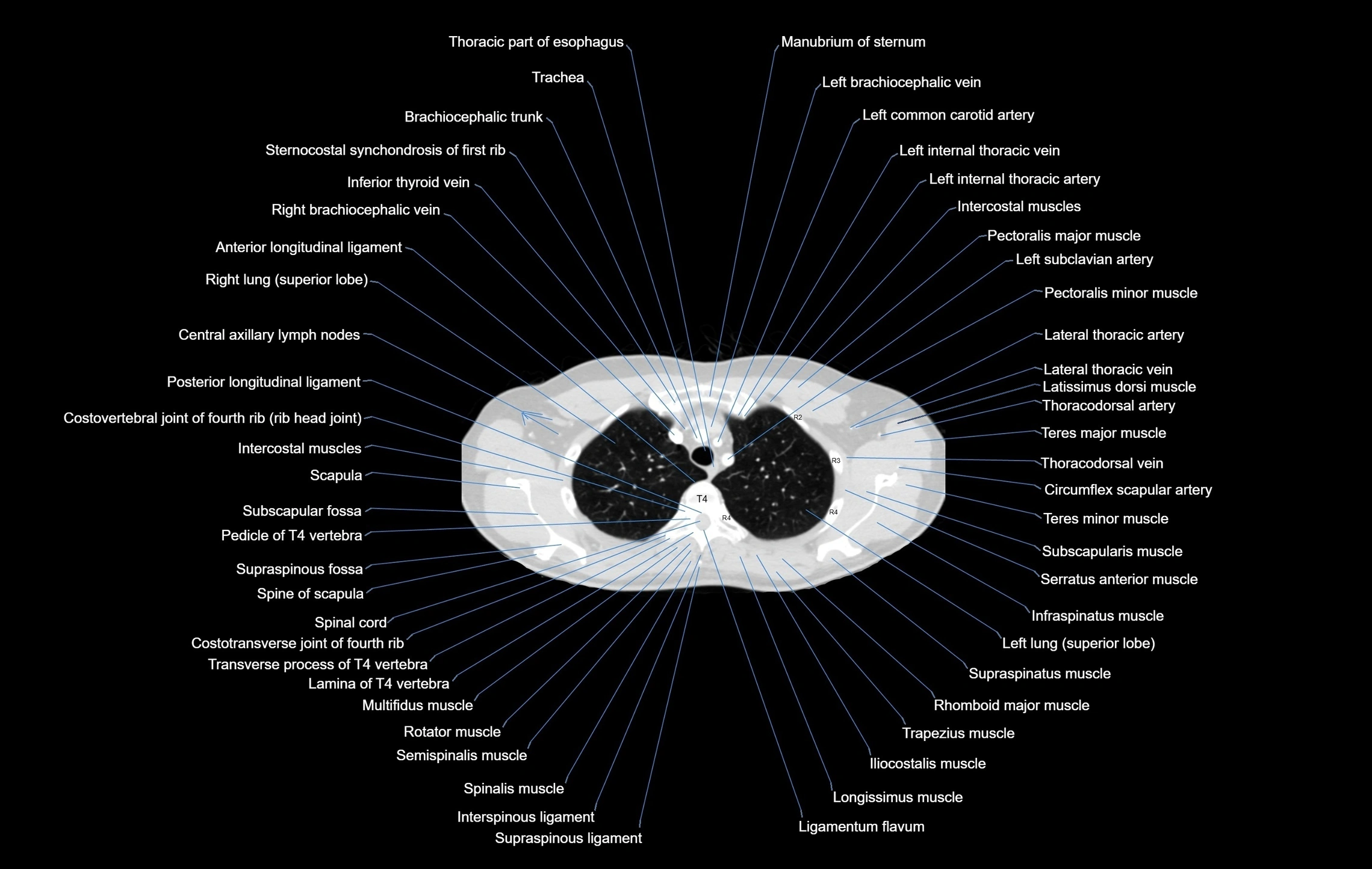 CT chest (thorax) labelled axial cross sectional anatomy radiology image-00025.webp